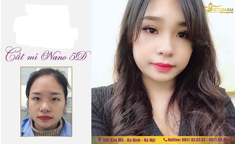 địa chỉ cắt nhấn mí mắt đẹp ở Hà Nội