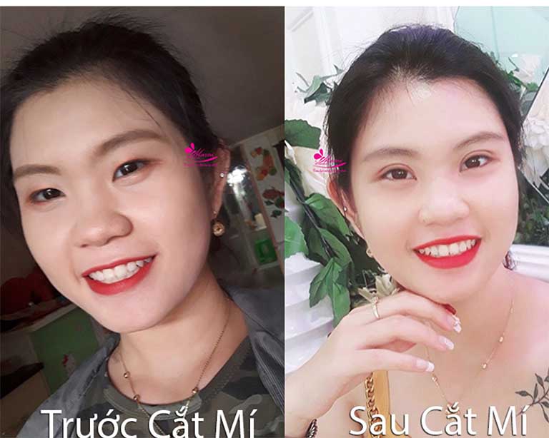 địa chỉ cắt nhấn mí mắt đẹp ở Hà Nội