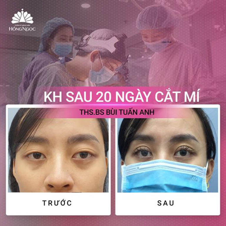 địa chỉ cắt nhấn mí mắt đẹp ở Hà Nội