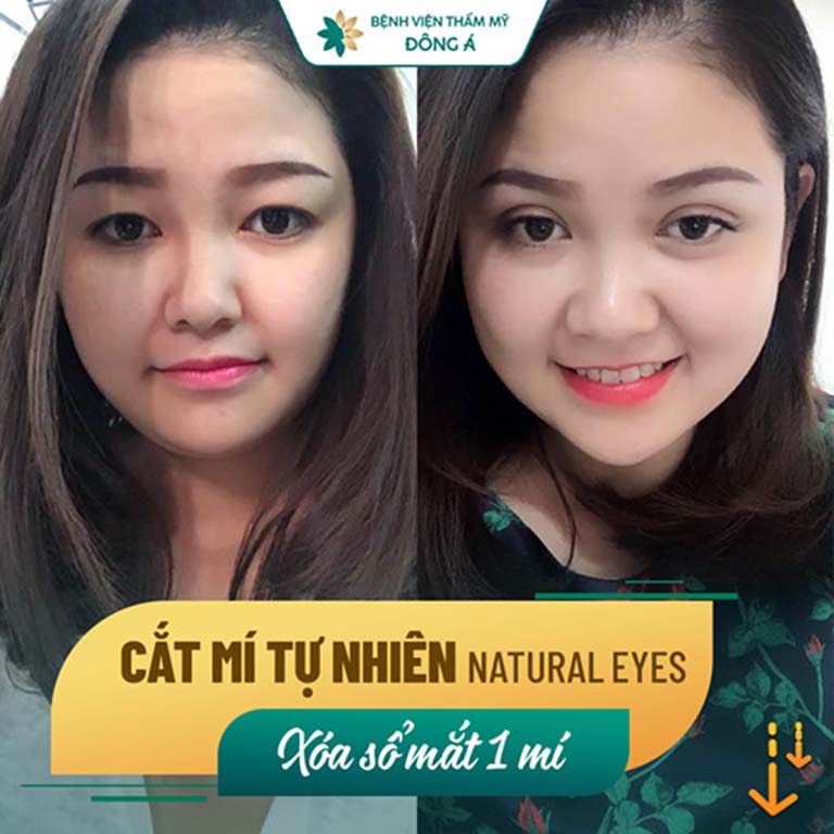 địa chỉ cắt nhấn mí mắt đẹp ở Hà Nội