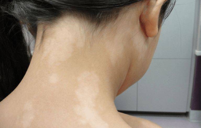 Lang ben có tự hết không là thắc mắc chung của nhiều người