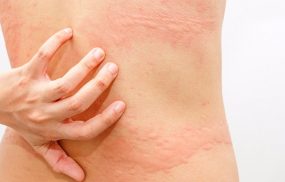 Ngứa do dị ứng thời tiết