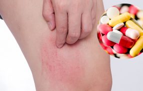 thuốc chữa dị ứng thời tiết