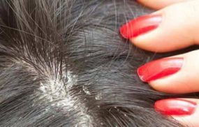 Nấm da đầu gây rụng là tình trạng thường gặp, chủ yếu do nấm Trichophyton và microsporum gây ra