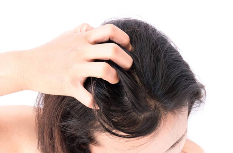 Thuốc trị nấm da đầu nizoral tốt không?