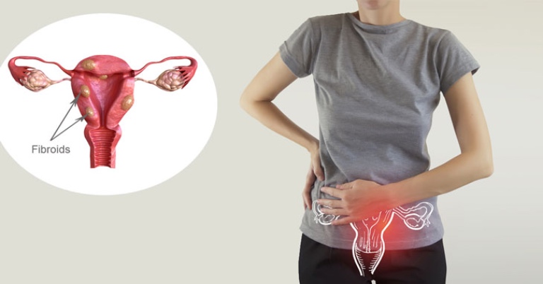 Bị u xơ tử cung có mang thai được không