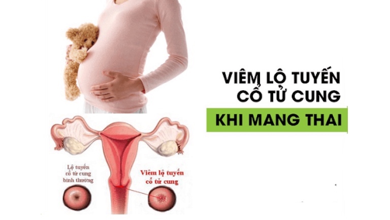 Mang thai bị viêm lộ tuyến có ảnh hưởng thai nhi không?