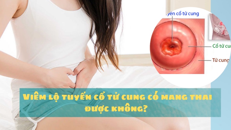 Viêm lộ tuyến cổ tử cung có mang thai được không? 