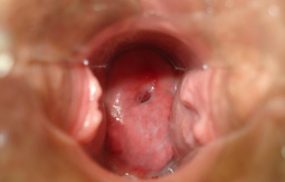viêm lộ tuyến độ 1