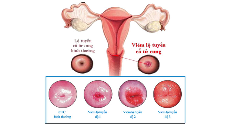Viêm lộ tuyến độ 2 