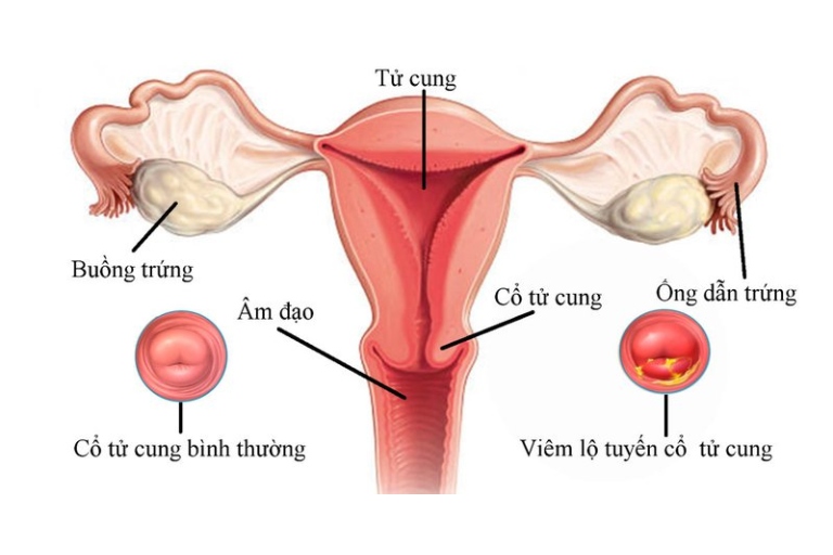 ra huyết trắng vón cục như bã đậu do đâu