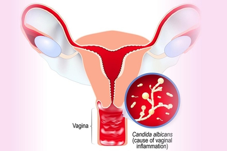 Nhiễm nấm Candida âm đạo