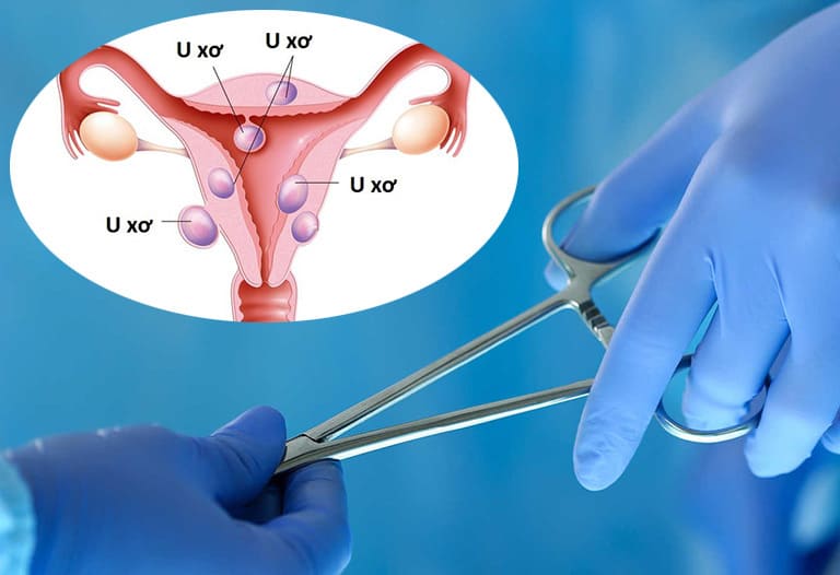 Mổ u xơ tử cung bằng phương pháp nội soi