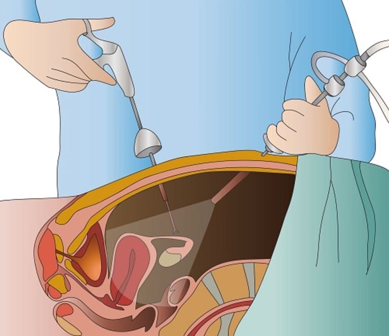 Mổ u xơ tử cung bằng phương pháp nội soi