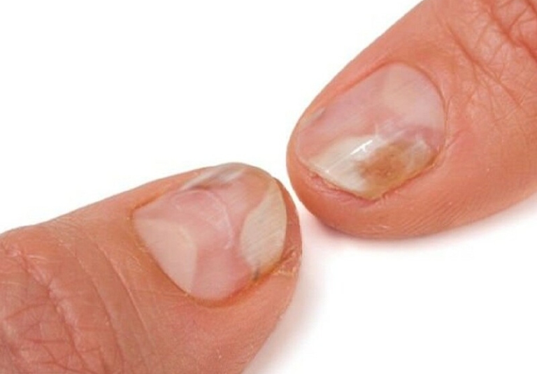 móng tay bị rỗ nguy hiểm không