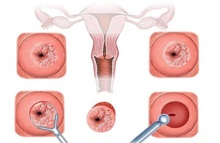 Ra huyết trắng màu nâu: Các bệnh phụ khoa có thể gặp
