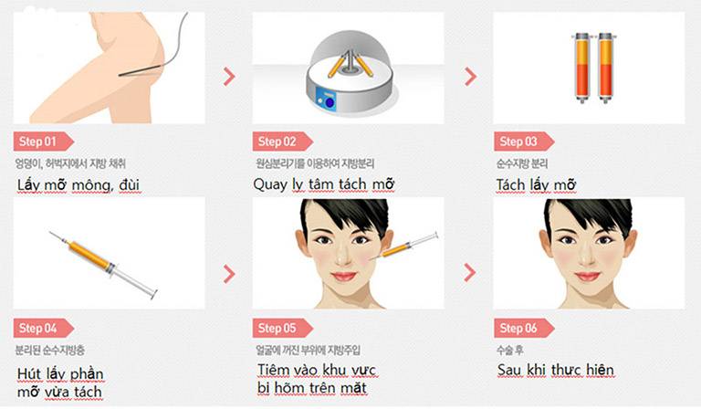 Nâng mũi bằng mỡ tự thân