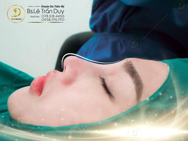 Nâng mũi bọc sụn megaderm là gì?