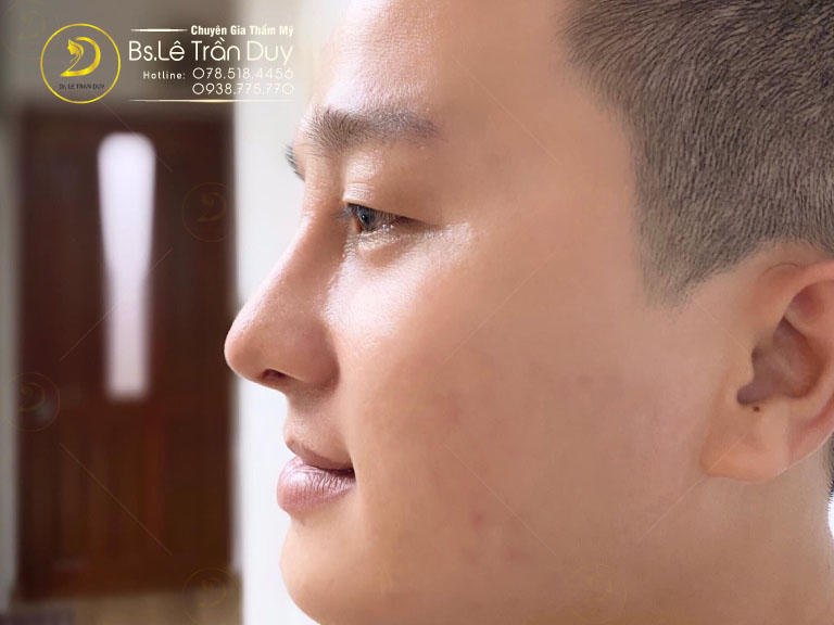 Nâng mũi nam Dr.Duy