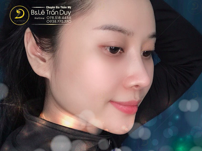 nâng mũi s line đẹp