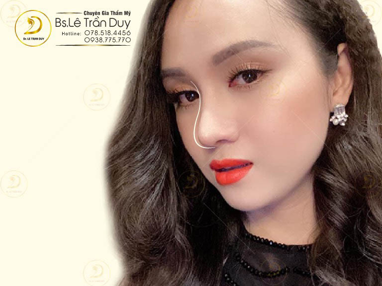 phương pháp nâng mũi s line