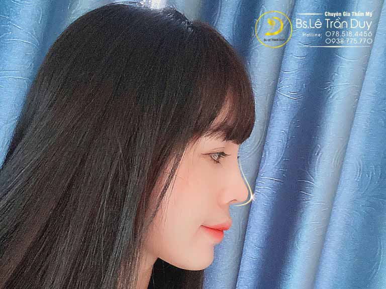 nâng mũi s line đẹp với bác sĩ giỏi