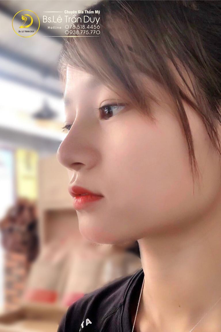 nâng mũi sụn tự thân giá bao nhiêu