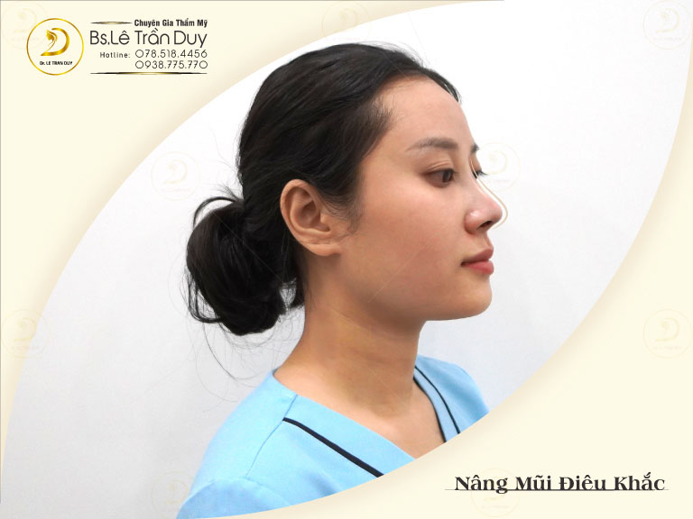 Nâng mũi vĩnh viễn giá từ 25 triệu đồng