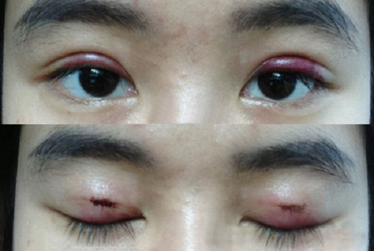 Biến chứng sau khi nhấn mí mắt