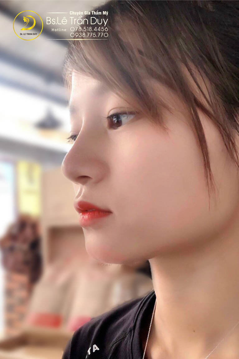 Nâng mũi bằng sụn tai liệu có bị teo lại không?