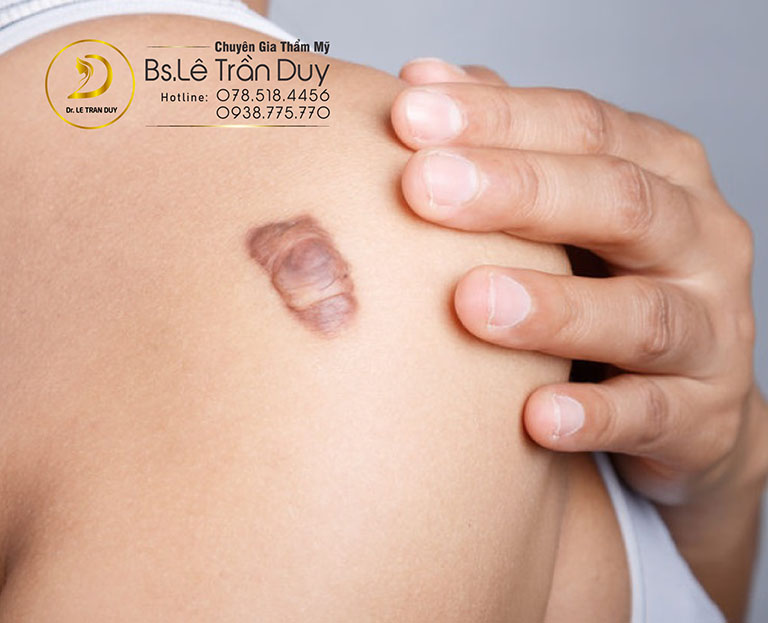 cách trị sẹo lồi hiệu quả