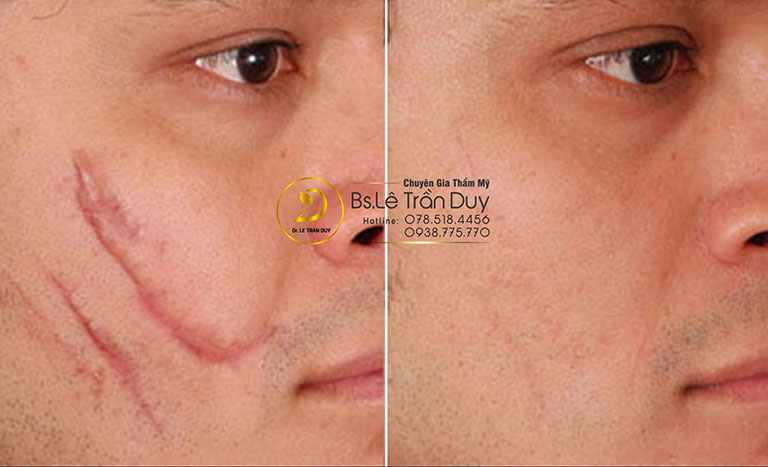 cách trị sẹo lồi trên mặt