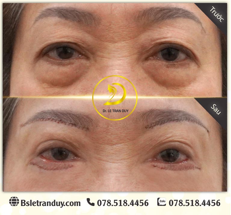 Cắt mí dưới loại bỏ bọng mỡ, da thừa, cho mắt trẻ trung to tròn với đường may thẩm mỹ chống sẹo cực kỳ đẹp được thực hiện ở bác sĩ Duy