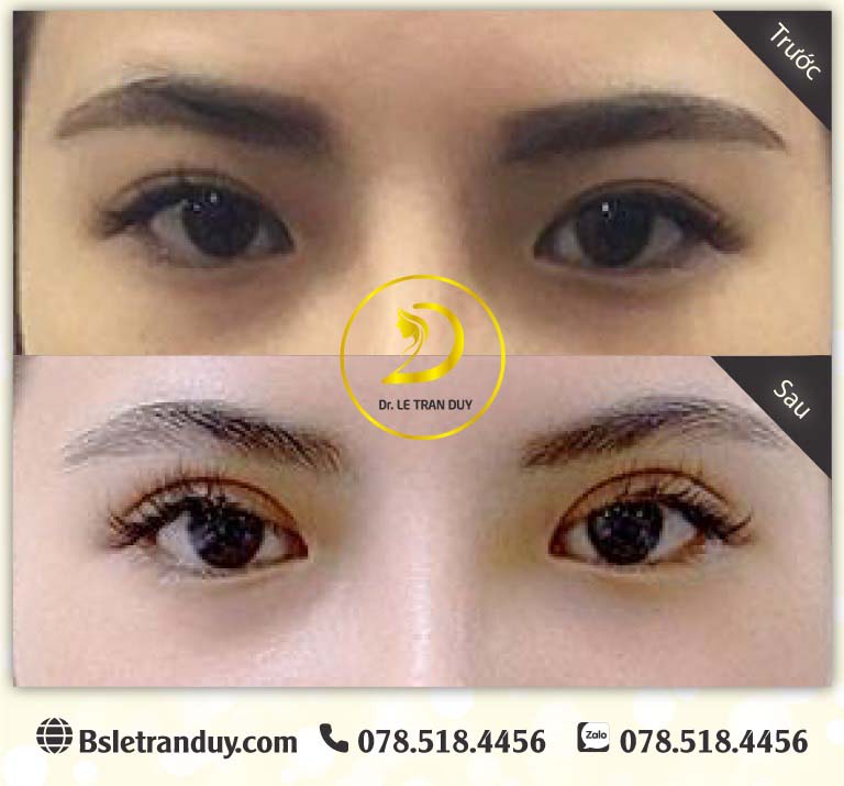 Cắt mí đẹp, mau lành với chế độ dinh dưỡng phù hợp