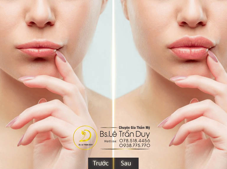 cắt môi trái tim đẹp