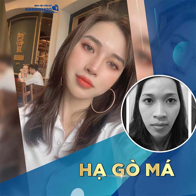 Hạ gò má nội soi tại bệnh viện thẩm mỹ GangWhoo 