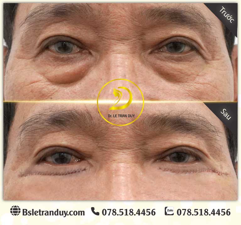 Có nên lấy mỡ bọng mắt?