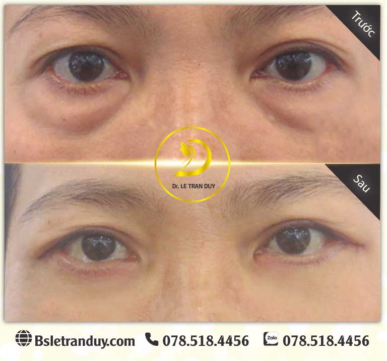 Lấy mỡ bọng mắt dưới