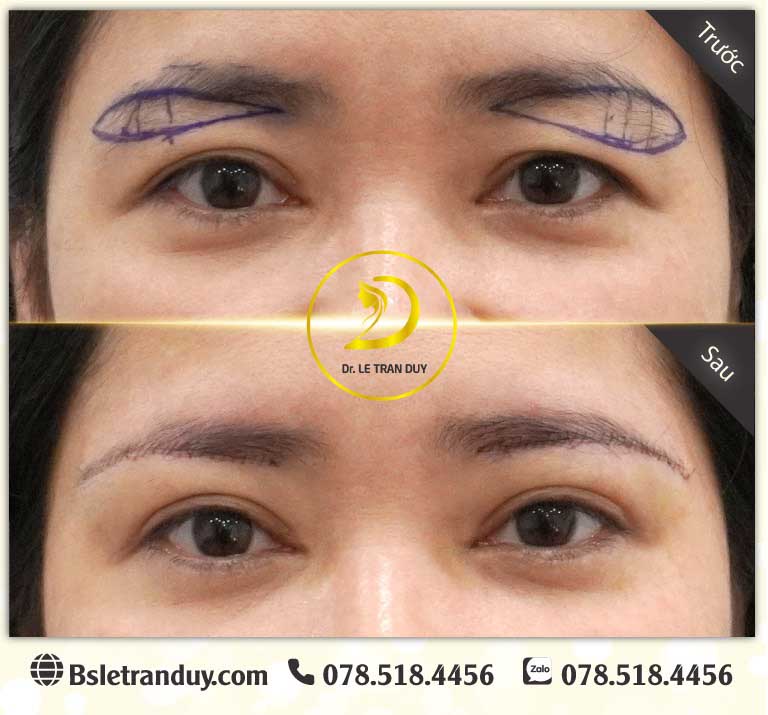 Nâng cung chân mày được bao lâu?