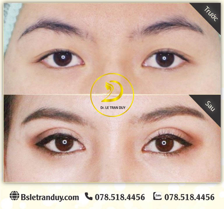 Đôi mắt 2 mí to tròn, cuốn hút mọi ánh nhìn nhờ thực hiện ở bác sĩ giỏi