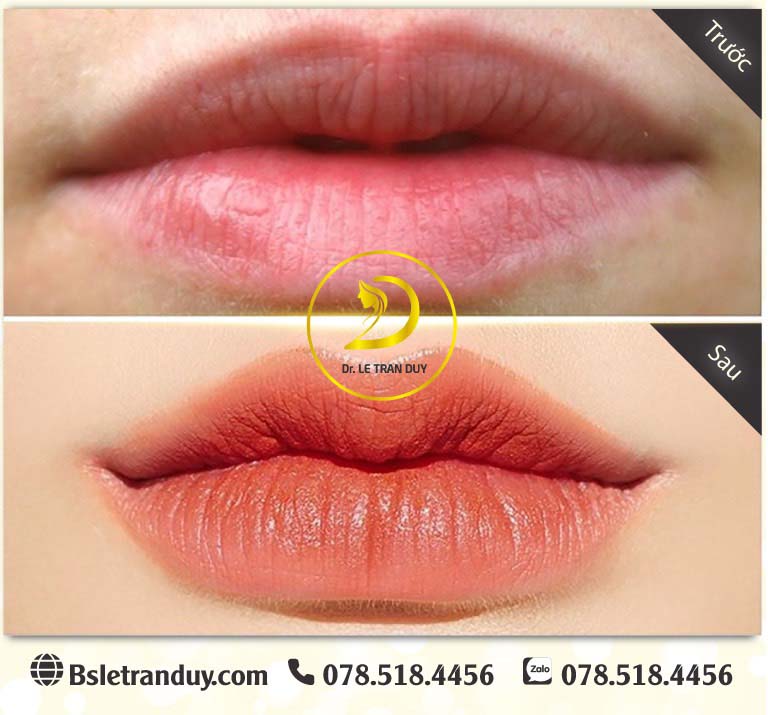 Tiêm filler môi đẹp an toàn với bác sĩ Lê Trần Duy