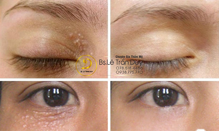 Mụn thịt không ảnh hưởng sức khỏe nhưng gây mất thẩm mỹ, điều trị mụn thịt ở bác sĩ giỏi mang đến hiệu quả tuyệt đối