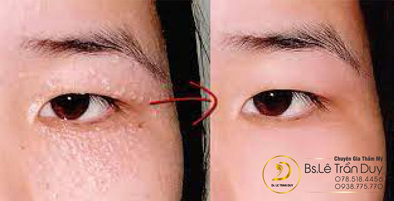 Mụn thịt không còn là nỗi lo, được xoá sạch sau 1 lần thực hiện ở bác sĩ giỏi