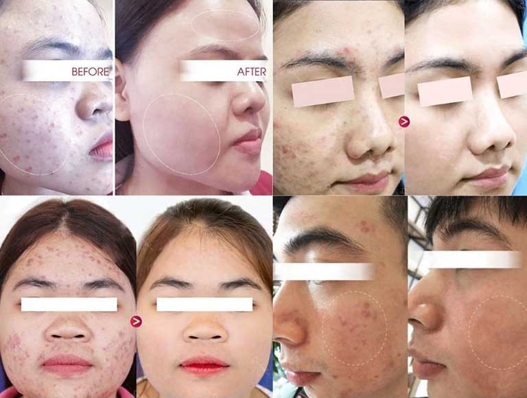 Điều trị mụn tại Seoul Spa TPHCM