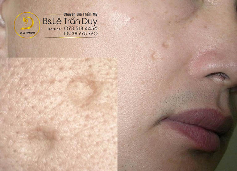 trị sẹo rỗ hiệu quả