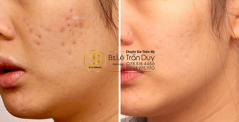 Trị sẹo rỗ an toàn và hiệu quả cao tại chuyên gia thẩm mỹ Bs Dr.Duy