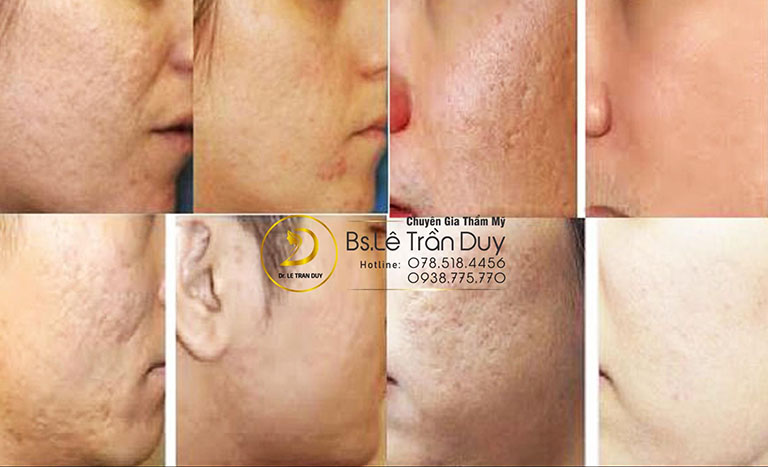 Tùy theo cơ địa và tình trạng sẹo rỗ mà bác sĩ chuyên môn sẽ đưa ra phương án điều trị phù hợp