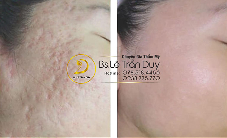 Phục hồi làn da hiệu quả sau khi điều trị sẹo rỗ tại Bác sĩ giỏi