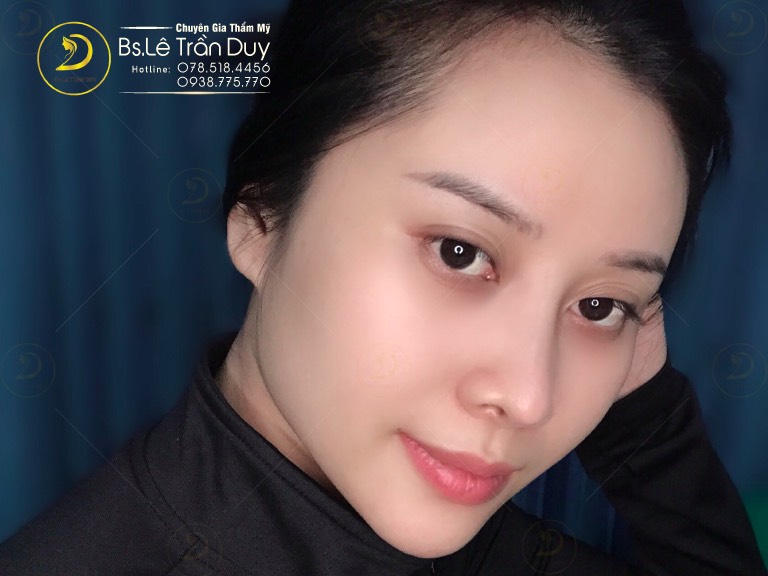 Xóa rãnh cười bao nhiêu tiền