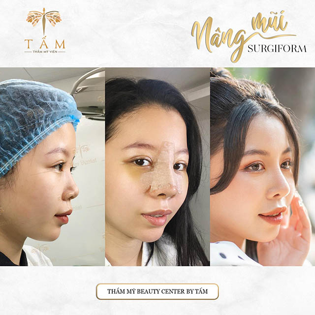 Nâng mũi đẹp tại TPHCM thẩm mỹ viện tấm uy tín được vimed đánh giá 